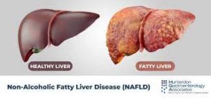 Nonalcoholic Fatty Liver Disease – Silent Epidemic